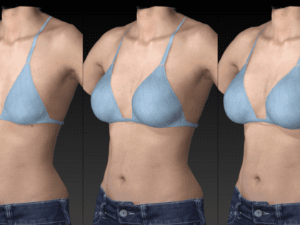 3D Göğüs Estetiği Simülasyonu