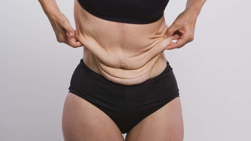 Obezite Cerrahisi Sonrası Deri Sarkma Ameliyatı
